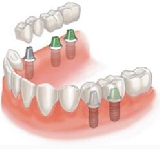 Виды несъёмного зубного протезирования