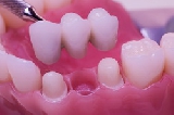 Виды зубных коронок