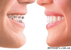 Аномалии зубов: краткая классификация